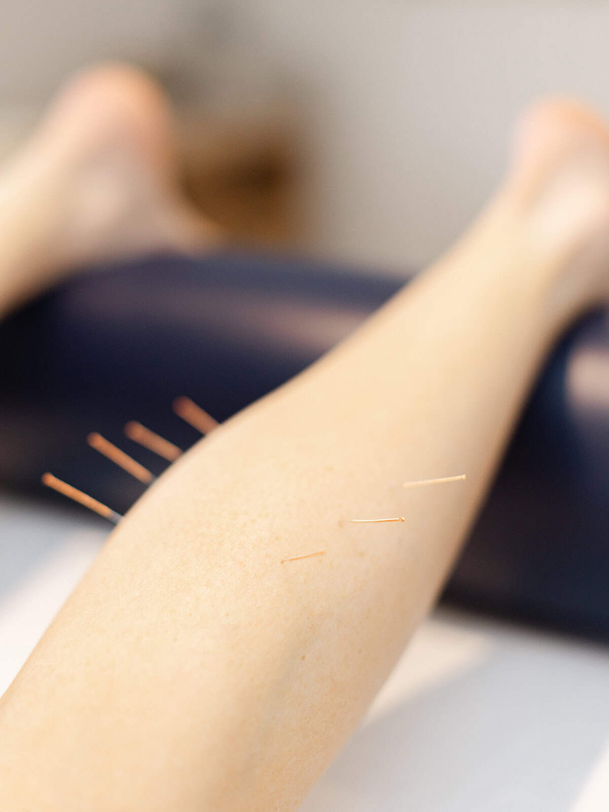 Acupuncture & Dry Needling